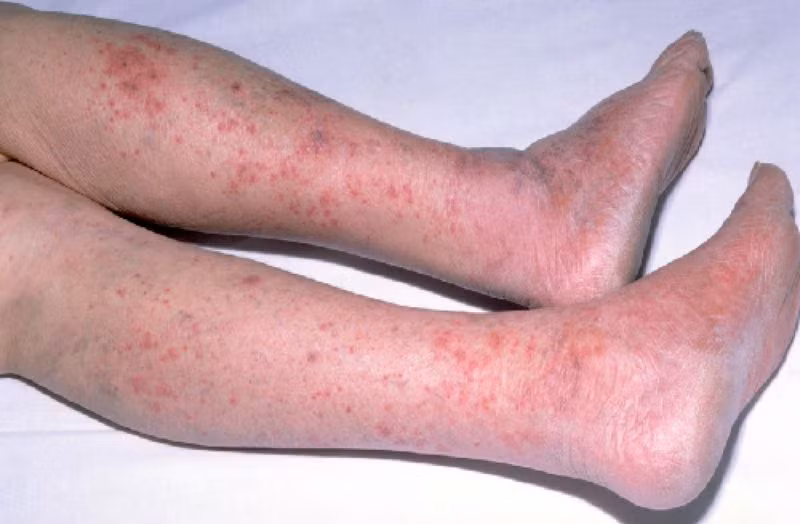 TP HCM: Be 5 thang tuoi tu vong vi viem nao mo cau