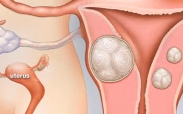 Chảy máu âm đạo bất thường củng có thể do chứng lạc nội mạc tử cung.