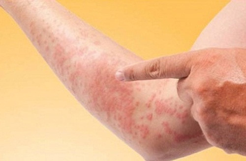 Dị ứng da. Sự chênh lệch nhiệt độ cùng sự thay đổi độ ẩm không khí là tác nhân gây ra các chứng bệnh da liễu như khô nẻ, da dị ứng, mẩn đỏ… Biểu hiện bệnh thường là da nổi mẩn đỏ, ngứa ngáy gây khó chịu…Để phòng bệnh, bạn có thể bôi kem dưỡng da để cung cấp độ ẩm cho da. Hơn hết, khi chưa tìm rõ nguyên nhân dị ứng, nên hỏi ý kiến bác sĩ trước khi sử dụng bất cứ loại thuốc nào.