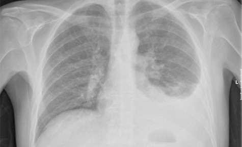 Lá tre điều trị bệnh viêm màng phổi có tràn dịch. Liều lượng: 20g lá tre, 20g thạch cao, 12g vỏ rễ dâu, 12g hạt rau đay, 12g hạt bìm bìm, 12g rễ cỏ tranh, 12g thổ phục linh, 12g bông mã đề, 600ml nước. Cách dùng: sắc xuống còn 200ml, uống hết 1 lần trước khi dùng bữa trưa khoảng 30 phút; sau đó thêm nước vào và sắc lần thứ 2 để uống trước bữa cơm chiều.