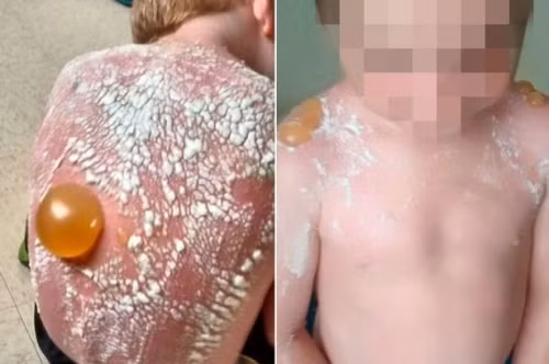 Nếu tiếp xúc với ánh nắng mặt trời quá lâu, đặc biệt càng nhỏ tuổi thì nguy cơ tăng sắc tố da của trẻ sẽ tăng lên rất nhiều và sẽ gây ra nhiều đột biến trên làn da của trẻ. Không chỉ làm da đen sạm đi, làn da bé sẽ bị mất nước và bị đỏ ửng, ngứa ngáy và nguy hiểm hơn, còn dễ bị ung thư da.