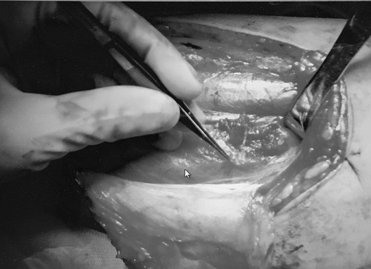 Đắp thuốc nam “vùng kín”, thanh niên bị cắt "của quý" ảnh 1