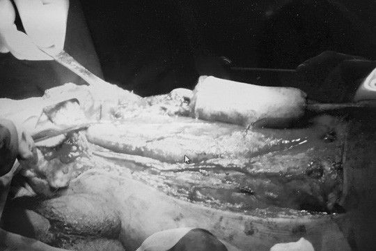 Tạo hình "của quý" cho một bệnh nhân sau phẫu thuật ung thư dương vật.