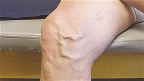 Chan noi gan, ngua ngay canh bao benh nguy hiem khong the chu quan