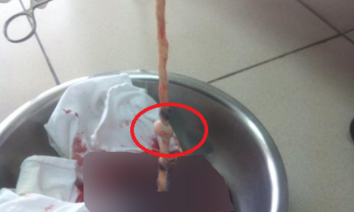 Thai nhi 40 tuan tuoi chet luu: Do day ron bi that nut-Hinh-2