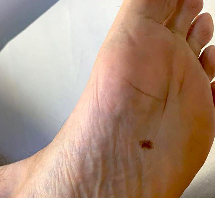 Nhung dau hieu tren chan co the “du doan” ung thu phoi-Hinh-2