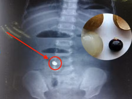 Xot xa chau be tu vong vi hoc hat nhan