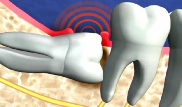 Răng khôn mọc lệch lạc có thể gây ra nhiều biến chứng khó chịu, ảnh hưởng đến sức khỏe như sâu răng, viêm lợi, hủy hoại xương và hàm răng. Ảnh: nhakhoakim.