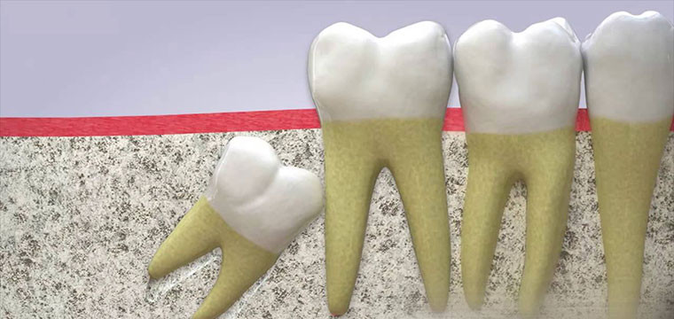 Không phải ai cũng có răng khôn. Ước tính có khoảng 35% dân số sẽ không mọc răng khôn. Ảnh: tgdd.