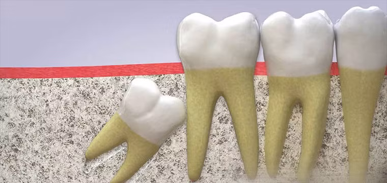 Không phải ai cũng có răng khôn. Ước tính có khoảng 35% dân số sẽ không mọc răng khôn. Ảnh: tgdd.