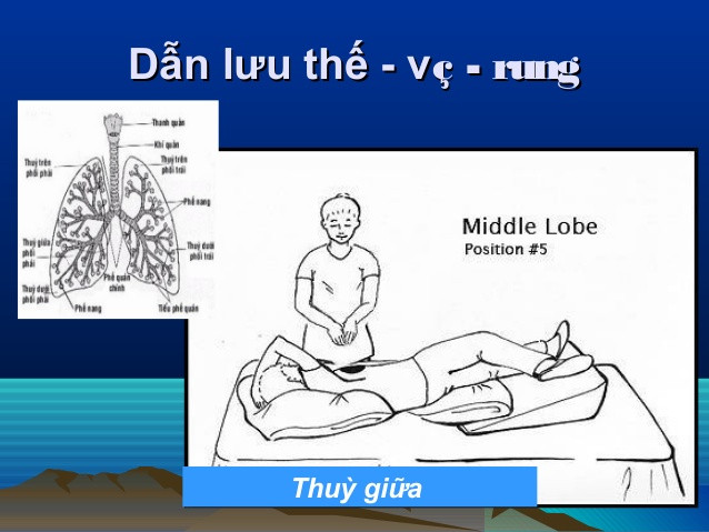 Dẫn lưu tư thế được thực hiện bằng cách nằm ở các vị trí khác nhau để sử dụng trọng lực loại bỏ chất nhầy ra khỏi phổi. Ảnh: slidesharecdn.