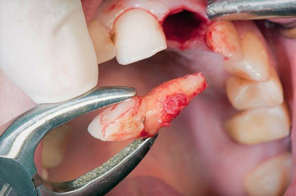 Ở một số người, sau khi nhổ răng khôn có thể xuất hiện tình trạng sưng một bên mặt. Ảnh: tramrang.