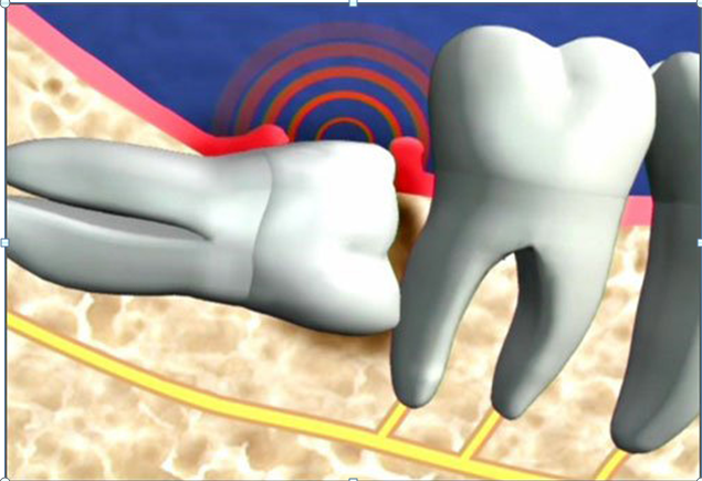 Bên cạnh đó, trong những ngày đầu tiên sau khi nhổ răng khôn, bạn không nên sử dụng ống hút bởi chúng sẽ nới lỏng các cục máu đông và làm chậm quá trình hồi phục. Ảnh: drhaidang.