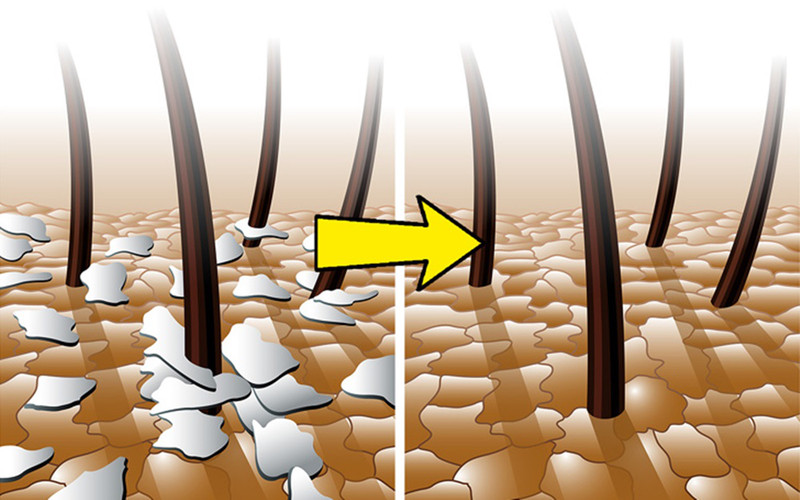 Trị gàu: Bạn sẽ không tự tin với mái tóc lấm tấm gàu. Một cách đơn giản để loại bỏ gàu là rắc một chút muối lên tóc và xoa bóp da đầu trong khoảng 5 phút trước khi gội đầu. Muối sẽ giúp bạn loại bỏ gàu, đồng thời giúp mái tóc bạn phát triển khỏe mạnh.