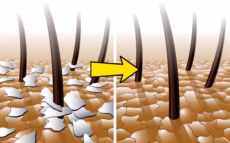 Trị gàu: Bạn sẽ không tự tin với mái tóc lấm tấm gàu. Một cách đơn giản để loại bỏ gàu là rắc một chút muối lên tóc và xoa bóp da đầu trong khoảng 5 phút trước khi gội đầu. Muối sẽ giúp bạn loại bỏ gàu, đồng thời giúp mái tóc bạn phát triển khỏe mạnh.