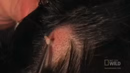 Một cảnh tượng khác ghê rợn không kém khi ấu trùng ký sinh của loài ruồi trâu được gắp ra khỏi đầu của một cô gái.Loài ruồi trâu hay còn gọi là BotFly có khả năng ký gửi trứng của mình vào những động vật khác như muỗi, sau đó muỗi đốt con mồi thì sẽ vô tình truyền ấu trùng vào vật chủ khác như gia súc hoặc người.