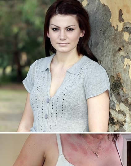 Cô gái dị ứng với nước. Cô gái Ashleigh Morris sống ở Melbourne, Australia. Cô không thể đi bơi hay ngâm mình trong bồn tắm vì mắc phải chứng bệnh quái gở aquagenic urticaria khiến cô bị dị ứng với nước. Nguyên nhân gây ra chứng bệnh này là penicillin. Trước đây, Ashleigh từng bị viêm amidan nặng và phải uống rất nhiều penicillin để chữa bệnh.