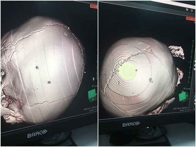 Be gai 3 tuoi bi nguoi tinh cua me dong dinh vao dau da tu vong