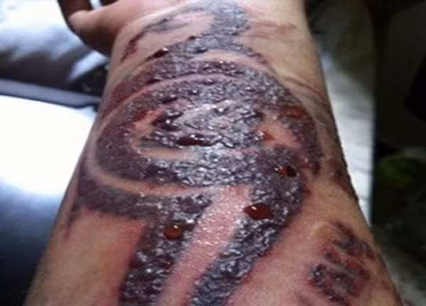 Một số bệnh về da như eczema hay vảy nến có thể gây ra những hậu quả nghiêm trọng khi xăm mình. “Bệnh nhân bị vẩy nến nếu xăm mình sẽ có nguy cơ gặp phải hội chứng Koebner khiến bệnh trầm trọng”, tiến sĩ Marie Leger, nhà da liễu học, Đại học New York, cho biết. Ngoài việc gây khó chịu, các tổn thương xuất hiện trên hình xăm sẽ rất lâu khỏi. Đối với bệnh nhân eczema, xăm hình có thể gây dị ứng vì da của họ quá nhạy cảm.