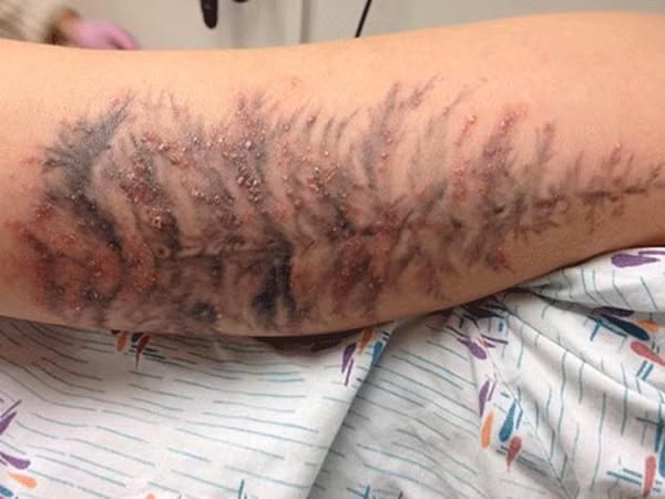  Trong số những người được khảo sát, 44% phản ứng mãn tính với mực đỏ, mặc dù chỉ có khoảng hơn 36% hình xăm sử dụng loại mực này. 1/3 số người phản ứng mãn tính với hình xăm màu đen trong khi có đến 90% người sử dụng xăm màu này.