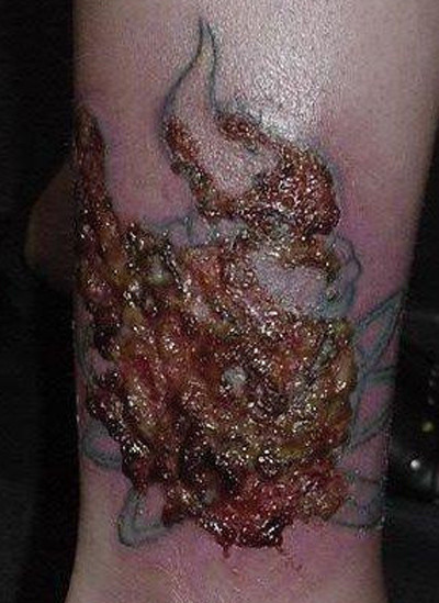 Nhiễm trùng da. Theo Prevention, thông thường, các loại mực xăm đều sử dụng nguyên liệu từ phẩm màu thực vật kèm theo nhựa, oxit sắt, muối kim loại, dễ gây đau và phỏng da. Còn các loại mực xăm thường có chứa hóa chất hữu cơ như hợp chất nitrogen, dẫn chất naptha, carbon. Ngoài ra, nó còn chứa các loại hợp chất độc hại như lithium, arsenic, sulphur.