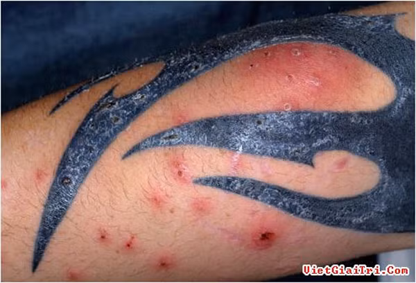 Theo Huffington Post, da là một cơ quan rất nhạy cảm trên cơ thể người, có khả năng phản ứng lại các tác động từ bên ngoài như thuốc dùng để xăm. Hầu hết biến chứng xảy ra tại các vùng da tiêm hai loại mực xăm phổ biến nhất là màu đỏ và đen.