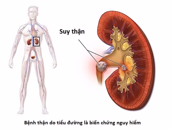 Đôi khi, ngay cả những thói quen thông thường cũng có thể gây hại cho thận của bạn và đến khi phát hiện ra thì đã quá muộn, thận không thể thực hiện tốt chức năng như kích thích tố sản xuất, lọc máu, hấp thụ chất khoáng, sản xuất nước tiểu và duy trì sự cân bằng axit-kiềm như trước đó. Vì vậy khi còn chưa muộn, hãy từ bỏ những thói quen hại thận sau. 