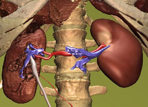 Ảnh hưởng của yếu tố di truyền. Những đối tượng có người thân từng mắc ung thư thận dễ đối diện với căn bệnh cao hơn bình thường. Trong số các dạng ung thư thận, ung thư do di truyền thường gây ra hội chứng Von Hippel-Lindau (VHL), bệnh sơ cứng ống thận, hội chứng Birt-Hogg-Dube, ung thư tế bào trong và tế bào kẽ của thận.