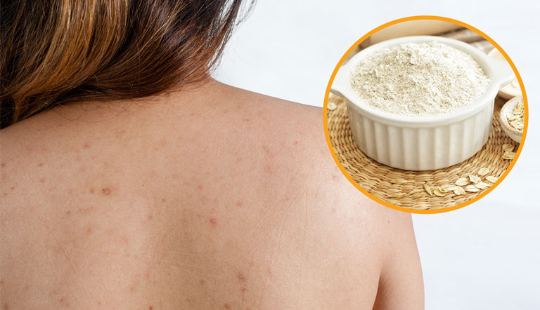 Với phương pháp trị mụn lưng từ yến mạch và mật ong, bạn nên thường xuyên thực hiện 1 lần/ngày để có hiệu quả tốt nhất. Ảnh: trungtamdalieudongy.