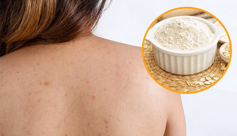 Với phương pháp trị mụn lưng từ yến mạch và mật ong, bạn nên thường xuyên thực hiện 1 lần/ngày để có hiệu quả tốt nhất. Ảnh: trungtamdalieudongy.