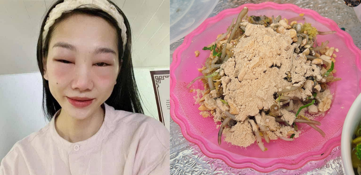 Nhận định về trường hợp dị ứng do ăn giá bể, các bác sĩ cho biết, thực khách có triệu chứng điển hình của phản vệ độ một hay phản ứng dị ứng nhẹ. Ảnh Internet