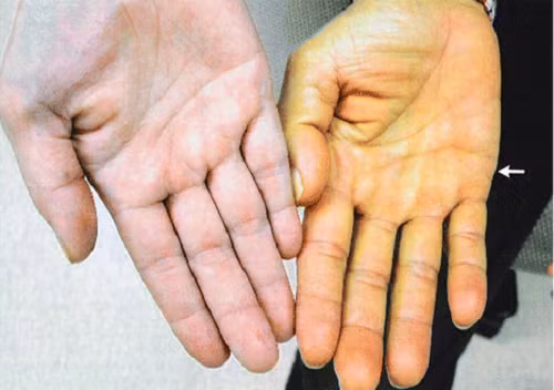 Bàn tay màu vàng nhạt là người khá vất vả. Họ thiếu quyết đoán trong công việc nên rất khó để thành công.