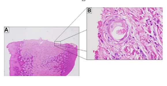 Co gai 25 tuoi moc long o nuou rang, bac si sung sot