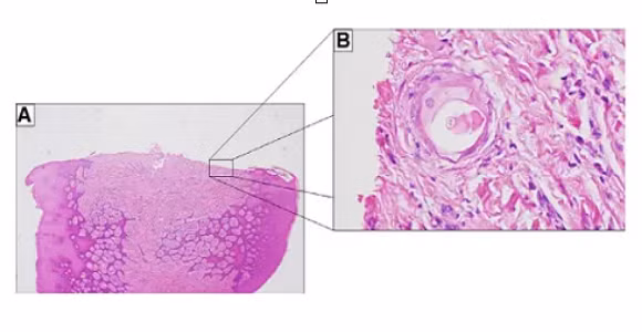 Co gai 25 tuoi moc long o nuou rang, bac si sung sot