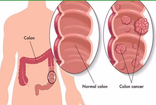 28 tuoi ung thu dai truc trang vi thoi quen nhieu nguoi mac