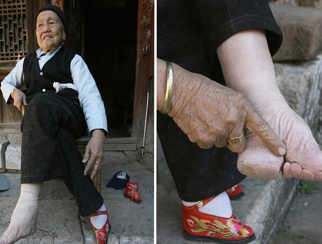 Đôi bàn chân biến dạng hoàn toàn đã gây ra trở ngại rất lớn trong việc đi lại, sinh hoạt hàng ngày. Ngoài ra, các cơn đau nhức kèm theo luôn đến “hành hạ” người phụ nữ