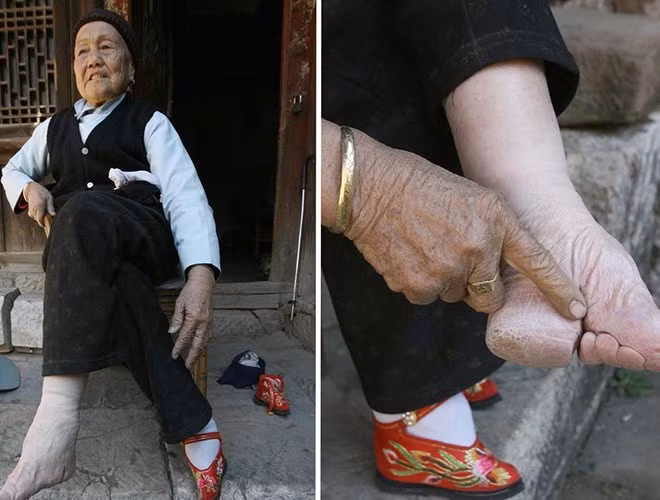 Đôi bàn chân biến dạng hoàn toàn đã gây ra trở ngại rất lớn trong việc đi lại, sinh hoạt hàng ngày. Ngoài ra, các cơn đau nhức kèm theo luôn đến “hành hạ” người phụ nữ
