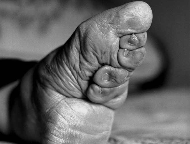 Các cô bé từ 5 đến 8 tuổi, độ tuổi mà xương còn chưa định hình hoàn toàn, phải dùng vải buộc chặt 4 ngón chân trừ ngón cái để ngăn không cho xương phát triển thêm và cố định khuôn bàn chân sao cho càng nhỏ càng tốt