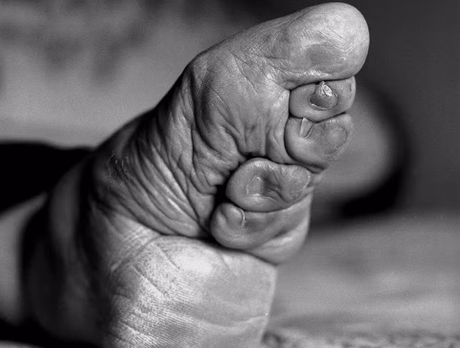 Các cô bé từ 5 đến 8 tuổi, độ tuổi mà xương còn chưa định hình hoàn toàn, phải dùng vải buộc chặt 4 ngón chân trừ ngón cái để ngăn không cho xương phát triển thêm và cố định khuôn bàn chân sao cho càng nhỏ càng tốt