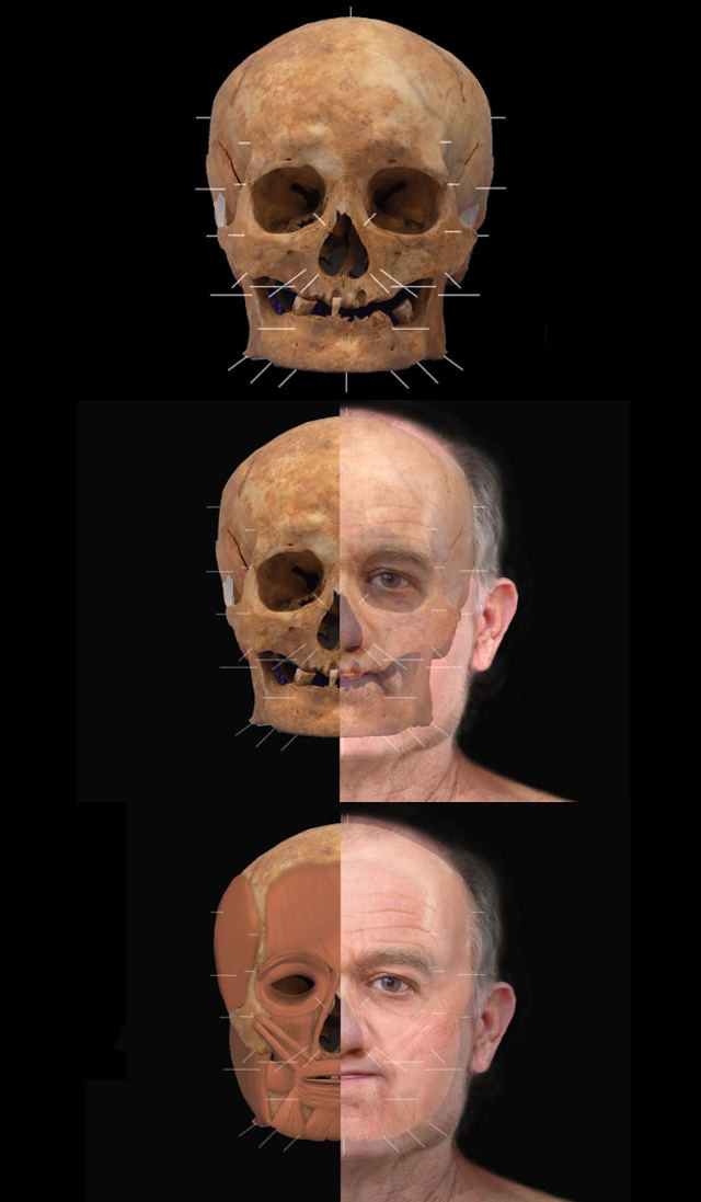 Cụ thể, một hàm của hài cốt "SK125" mất nhiều răng. Tình trạng hai hàm răng cho thấy trong suốt nhiều năm người đàn ông này gặp vấn đề nghiêm trọng về răng và nướu. Điều này dẫn đến tình trạng bị gãy răng, áp xe răng mãn tính và sâu răng.