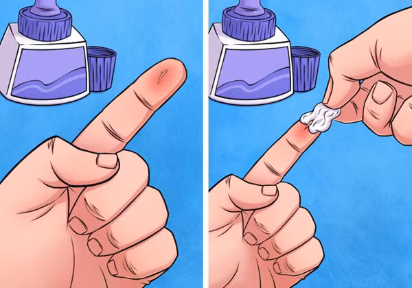 Lấy dằm tay bằng keo dán thủ công: Bị dằm đâm tay sẽ rất khó chịu. Thay vì dùng kim để lẩy ra thì bạn có thể tận dụng keo dán thủ công. Bạn cần chọn được loại keo tốt, có màu trắng và dễ khô. Khi thực hiện, bạn đổ lượng keo phù hợp vào chỗ có dằm và đợi khô. Tiến hành bóc lớp keo khô, chiếc dằm sẽ cùng chúng đi ra, giúp giảm cảm giác khó chịu.