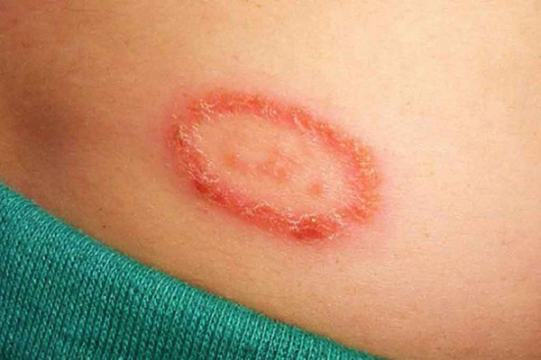 Chàm còn là một trong những dấu hiệu cơ thể tích tụ nhiều độc tố. Trung y cho rằng, cơ thể con người dễ sinh ẩm, ẩm là do cơ thể có quá nhiều độc tố. Khi cơ thể bị chàm, điều này thể hiện trong cơ thể có quá nhiều độc tố, cần giải độc càng sớm càng tốt.