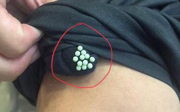 Về vấn đề này, Steve Jacobs – người chuyên nghiên cứu về côn trùng, làm việc tại Đại học Penn State (Mỹ) khẳng định, chất dịch bọ xít để lại không chỉ gây mùi khó chịu mà còn có thể khiến người mặc dị ứng. Trường hợp nhẹ, bạn sẽ bị chảy nước mắt, mũi. Trường hợp nặng, bạn có thể đối diện với tình trạng bỏng, tổn thương da và điều này đặc biệt nguy hại với trẻ em.