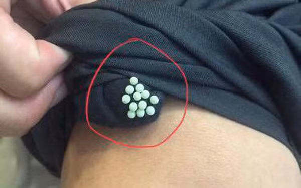 Về vấn đề này, Steve Jacobs – người chuyên nghiên cứu về côn trùng, làm việc tại Đại học Penn State (Mỹ) khẳng định, chất dịch bọ xít để lại không chỉ gây mùi khó chịu mà còn có thể khiến người mặc dị ứng. Trường hợp nhẹ, bạn sẽ bị chảy nước mắt, mũi. Trường hợp nặng, bạn có thể đối diện với tình trạng bỏng, tổn thương da và điều này đặc biệt nguy hại với trẻ em.