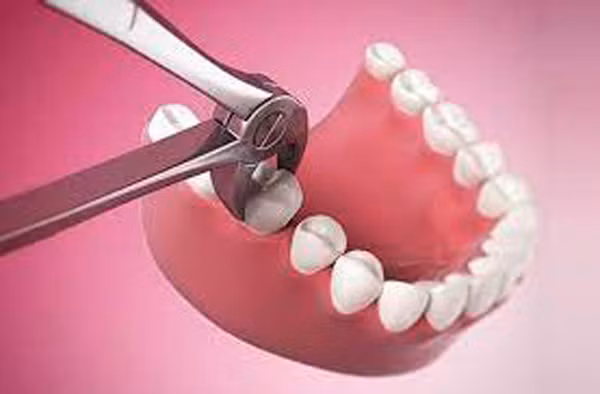 Nhổ răng: Phụ nữ nên tránh nhổ răng trong và sau kỳ kinh nguyệt. Thời điểm này, thể chất suy giảm, chức năng đông máu cũng kém đi. Nếu bất chấp tiến hành nhổ răng sẽ gây chảy máu nhiều hơn.