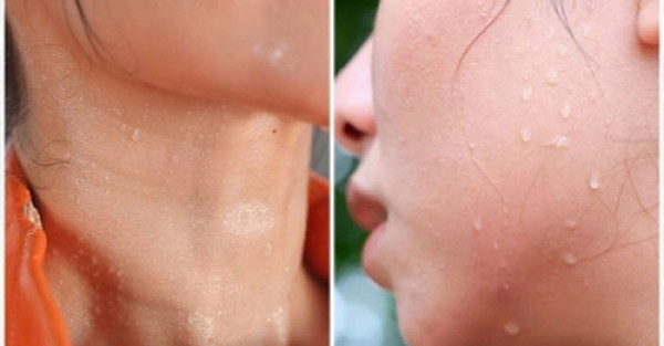 Đổ môi hôi cổ - rối loạn nội tiết: So với các vị trí khác, tuyến mồ hôi vùng cổ phân bố thưa thớt hơn. Điều này giải thích vì sao vùng cổ thường ít đổ mồ hôi.