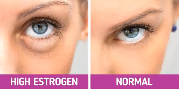 Điều hòa estrogen: Mất cân bằng estrogen có thể gây nên các triệu chứng như tăng sắc tố da, gương mặt phù nề, rạn da... Do vậy, điều hòa estrogen trong cơ thể cũng là cách trị tận gốc tình trạng phù nề ở mặt.