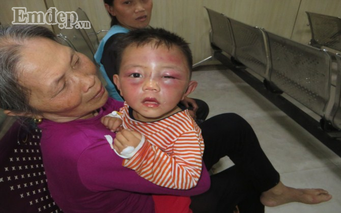 Cháu H bị cha dượng bạo hành dã man.