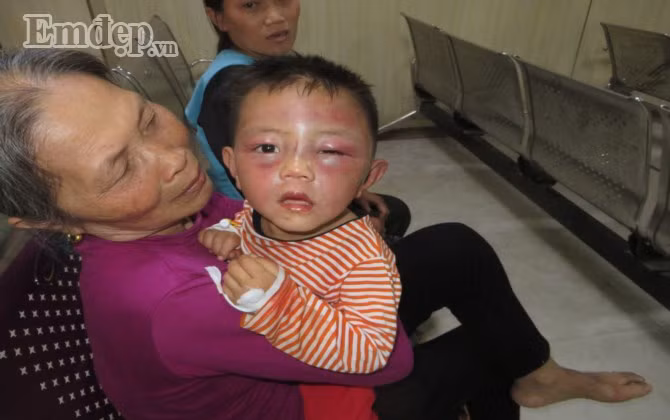 Cháu H bị cha dượng bạo hành dã man.