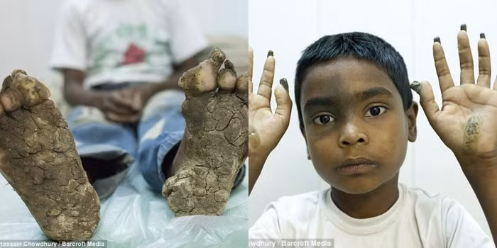 Kho so voi can benh tay, chan moc tua tua nhu re cay-Hinh-2